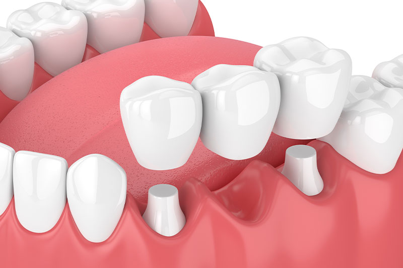 Dental Bridges in Surprise